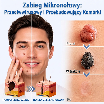 🔥🚚PuraCure® 2-w-1 plaster mikroigłowy i hydrokoloidowy🍀 | Usuwa wypukłe znamiona, trądzik, płaskie brodawki i brodawki skórne | Pomaga poprawić zmarszczki, blizny i niedoskonałości | Niewidoczne plastry na twarz i ciało